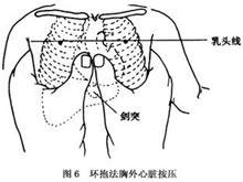 小儿心搏呼吸骤停