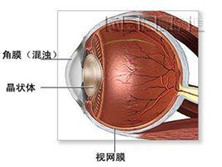 晶状体相关葡萄膜炎