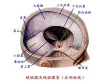 颅内出血