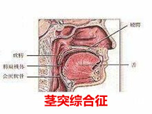 茎突综合征