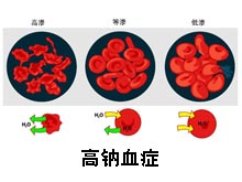 高钠血症