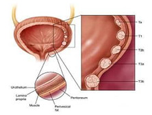 膀胱平滑肌肉瘤