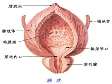 膀胱腺癌