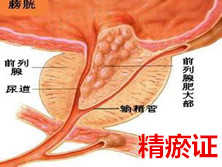 精瘀证