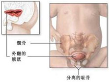 膀胱不发育与发育不全