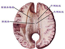 胼胝体进行性变性