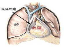 胸腺癌