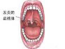 慢性扁桃体炎