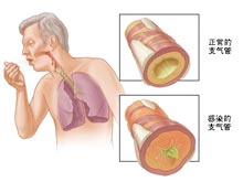 慢性支气管炎