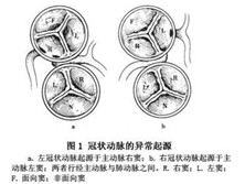 冠状动脉异常起源于主动脉