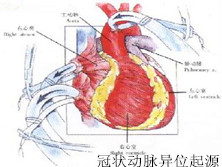 冠状动脉异位起源