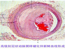 冠状动脉粥样硬化性心脏病