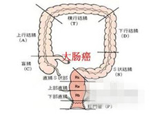 结直肠癌