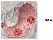 慢性消化性溃疡
