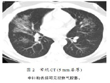 肝肺综合症