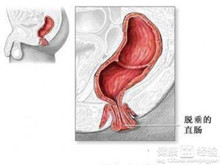 小儿直肠脱垂