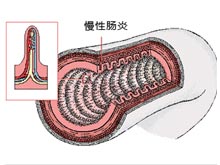 慢性肠炎