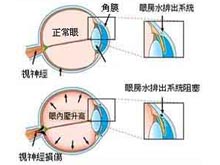 高眼压症