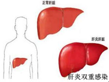 肝炎双重感染