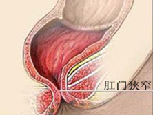 肛管、直肠、结肠狭窄