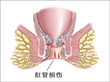 肛管损伤