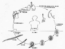 钩虫性十二指肠炎综合征