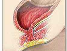 肛门闭锁