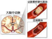 脑干梗塞