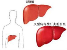 庚型病毒性肝炎