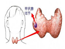 甲状腺结节样病变