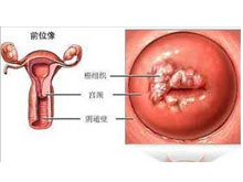 宫颈癌前病变