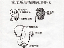 泌尿系统结核