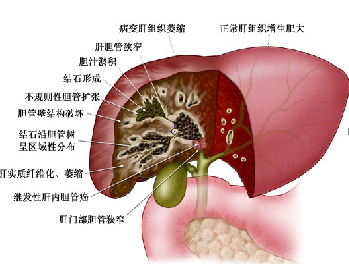 肝胆管结石