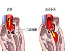 先天性主动脉瓣下狭窄