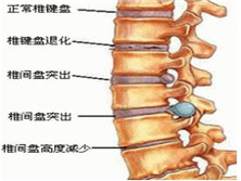 腰间盘突出