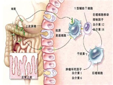 炎性肠病