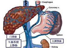 脾-肝综合征