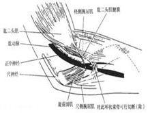 旋前圆肌综合征