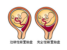 前置胎盘