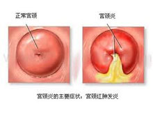 慢性宫颈炎