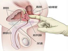 慢性前列腺炎