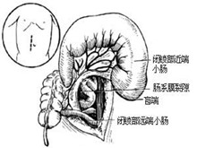 先天性结肠狭窄和闭锁