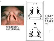 鼻瓣区狭窄