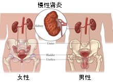 慢性肾炎