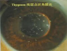 Thygeson浅层点状角膜病变