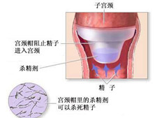 阴道纵隔