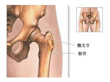 股骨颈骨折