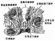 肛管直肠周围脓肿