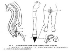 下部附加前根脊髓动脉缺血症候群