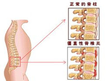 僵直性脊柱炎